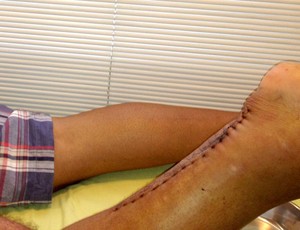 cicatriz Adriano (Foto: Divulgação)