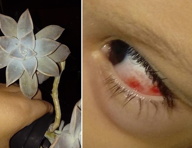 Davi sofreu lesão nos dois olhos após brincar com a planta (Foto: Reprodução Facebook)