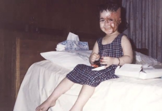 Após o acidente, quando tinha dois anos, Basma teve 40% de seu rosto queimado (Foto: Arquivo Pessoal)