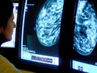 Colesterol 'alimenta' câncer de mama, diz estudo