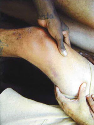 Foto mostra lesão em preso (Foto: Divulgação/Condepe)