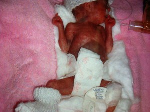 Bebê nasceu com apenas 25 semanas de gestação (Foto: Vanessa Moltini/ RBS TV)