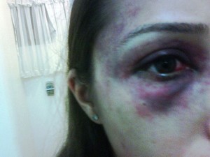 Ex namorada mostra as marcas da agressão que teria sido cometida por Christiano Rangel (Foto: Arquivo Pessoal)
