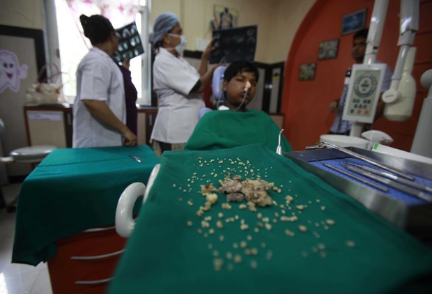 Ashik Gavai teve 232 debtes extraídos durante cirurgia em hospital de Mumbai, na Índia (Foto: Imtiyaz Shaikh/Anadolu Agency/Getty Images)
