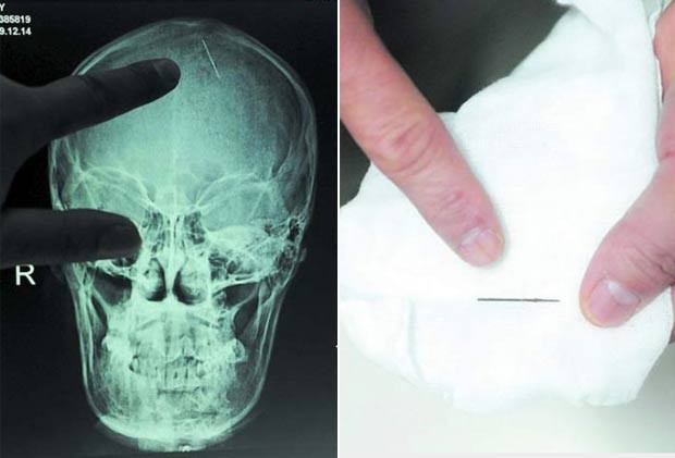 Imagem de raio-X mostra uma agulha de 2,5 centímetros que ficou por 20 anos encravada na cabeça da chinesa Zhou Chaozheng, que mora na província de Hunan. Ela passou por uma cirurgia em outubro de 2010 após começar a sentir dores de cabeça depois de dar à luz (Foto: Barcroft Media/Getty Images)