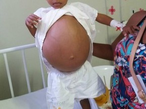 No Ap Exames Apontam Diagnostico De Menino Com Inchaco Na Barriga Amapa G1