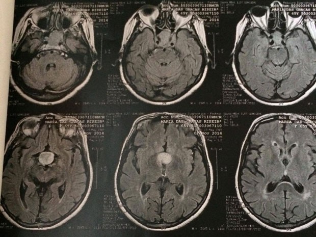 Resultado de exame feito por Maria das Graças Ribeiro dos Santos mostra tumor no cérebro (Foto: Reprodução)