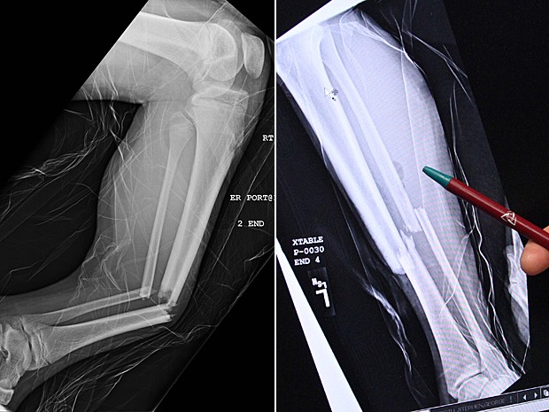 À esq., tíbia e fíbula quebradas após salto em trampolim. à esq., outro raio-X (Foto: Utah Valley Regional Medical Center/Rick Bowmer/AP)