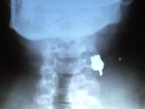 Imagem de raio-x mostra bala alojada no pescoço de Alex (Foto: Arquivo pessoal/Divulgação)