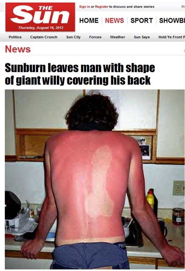 Reportagem no jornal 'The Sun' publicou fotos de queimaduras exageradas e com formas estranhas (Foto: Reprodução)