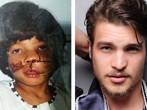 Modelo de Brasília Ecktor Lopes,de 26 anos, descobriu um tumor no nariz aos 9 anos (Foto: Ecktor Lopes)