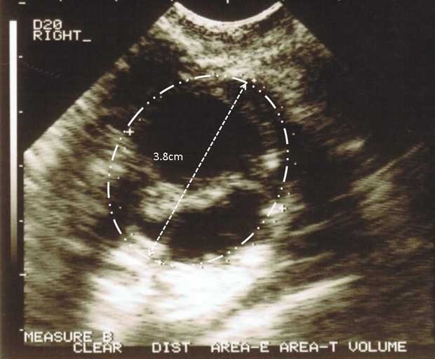 Imagem de aparelho de ultrassom mostra ovário com tumor (Foto: Cancer Genome Atlas/NIH)