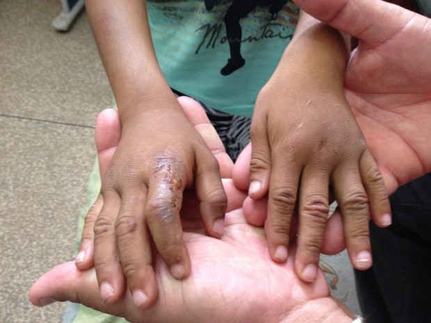 Menino de 8 anos apresentava queimaduras nas mãos feitas pelo pai (Foto: Anne Karoline/G1)