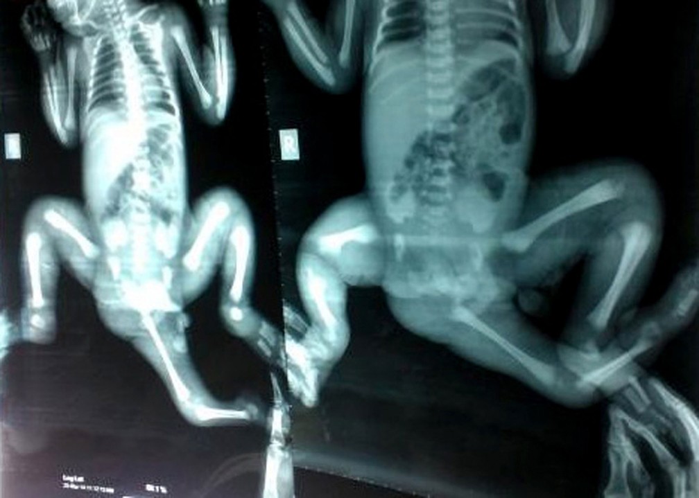 Raio-X feito antes da cirurgia mostra terceira perna da menina Choity Khatun, de 3 anos. Cirurgia foi bem-sucedida em remover órgão 