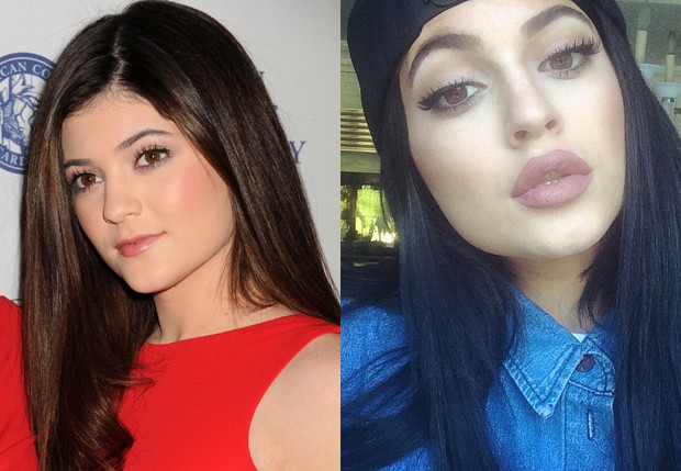 Kylie Jenner antes e depois do preenchimento labial