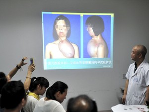 Médicos de um hospital em Fuzhou, na província de Fujian, na China, apresentam procedimento em que retiraram pele da perna de paciente para reconstituir um rosto em seu peito; pele foi transplantada, na segunda-feira, em seu rosto. (Foto: Reuters/China Daily)