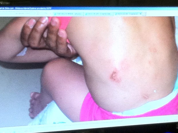 Nas costas da criança, também há marcas das agressões (Foto: Cristiane Cardoso/G1)