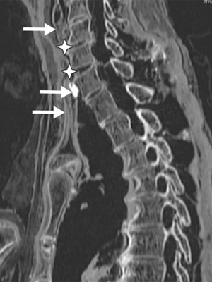 Tomografia mostra coluna e pescoço de faraó; estrelas indicam local onde ferimento foi causado (Foto: Reprodução/"British Medical Journal")