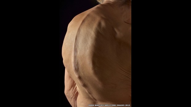  Foto de Mark Bartley, que trabalha no Hospital Addenbrooked, em Cambridge, mostra as costas d euma mulher de 79 anos mostrando uma coluna extremamente curvada (Foto:  Mark Bartley/Wellcome Images 2015)