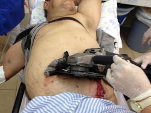 Serra elétrica cravada em abdome de agricultor no RS (Foto: Hospital Vida e Saúde/Divulgação)