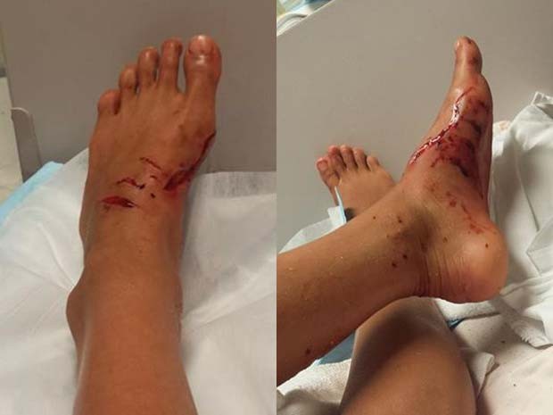 Kirra-Belle Olsson teve ferimentos no pé e na panturrilha após ser atacada por tubarão enquanto surfava nesta sexta (Foto: Divulgação/Kirra-Belle Olsson/ Facebook)