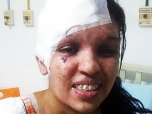 Aline teve testa e ombro cobertos aps cirurgia em Santos (Foto: Vanessa Cristina Reis/Arquivo Pessoal)
