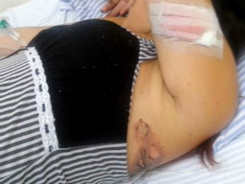 Laíssa teve ferimentos nas duas pernas e no braço esquerdo (Foto: Laíssa Britto / Arquivo pessoal)