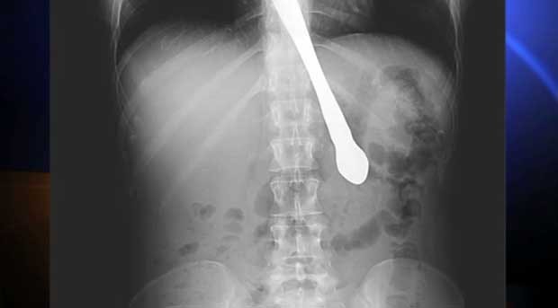 Radiografia mostra faca que foi engolida pela mulher (Foto: Reprodução)