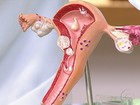 HPV causa 90% dos casos de câncer de colo de útero