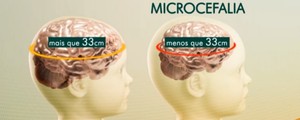 399 bebês com microcefalia foram registrados em 7 estados neste ano (Tv Globo)