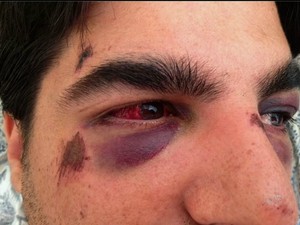 Advogado teve os dois olhos roxos após agressão (Foto: TV Verdes Mares/Reprodução)