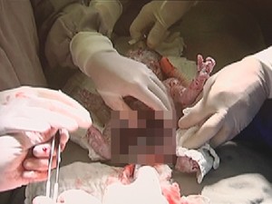 Bebê passa por cirurgia inédita (Foto: Reprodução/ TV TEM)
