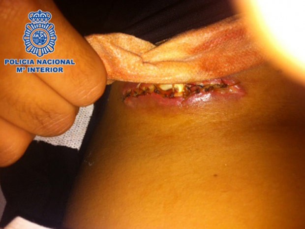 Polícia espanhola prende mulher que levava cocaína em implantes de seios (Foto: Polícia da Espanha/Divulgação)
