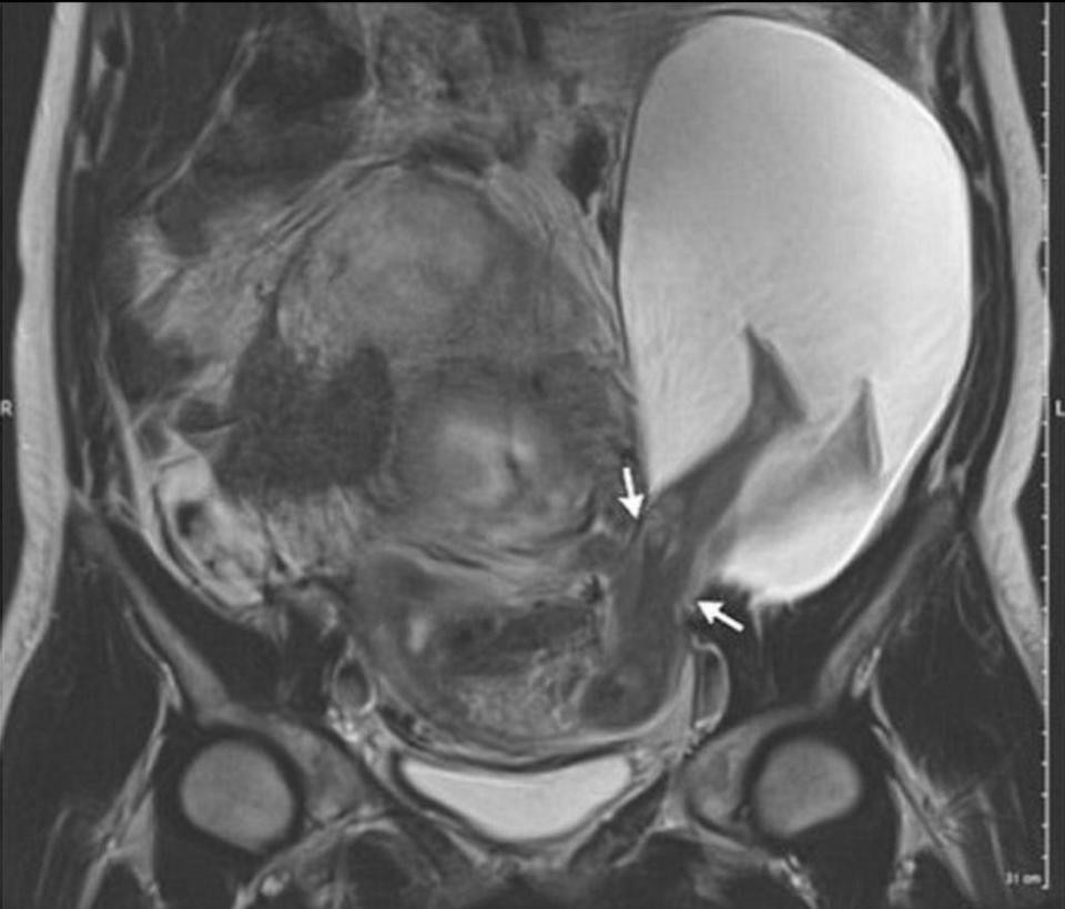 Mulher Gerou Bebe Com As Pernas Fora Do Utero Pagenotfound O Globo