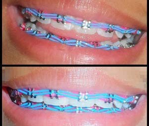 Jovens usam acessrios dentrios de maneira irregular (Foto: Aparelhos Diferenciados/Divulgao/Facebook)