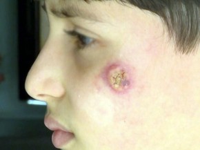 Higiene E Unica Forma De Combater Leishmaniose Diz Infectologista Sul De Minas G1