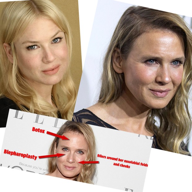 Renée Zellweger - a mudança drástica da atriz (Foto: Getty Images)
