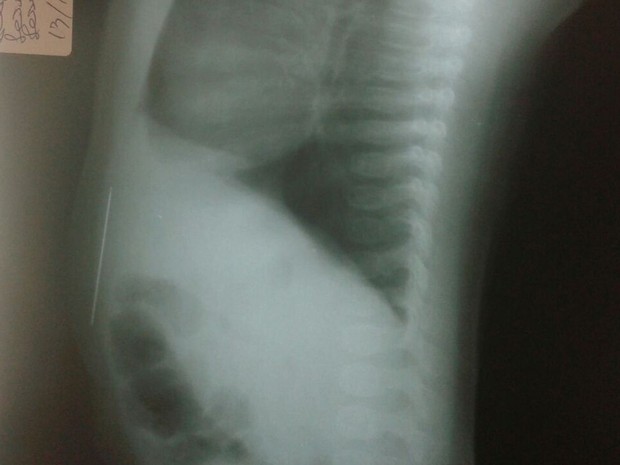 Equipe médica tentou e não conseguiu retirar agulhas do corpo do bebê (Foto: Divulgação)