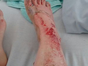 Uma das vítimas ficou com a perna toda machucada (Foto: G1) Uma das vítimas ficou com a perna toda machucada (Foto: G1)