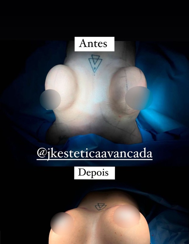 Maria Lina mostra antes e depois das cirurgias plásticas  (Foto:  Reprodução/ Instagram)