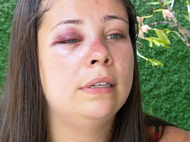 Marcas de agressões geraram revolta nas redes sociais em Três Corações (Foto: Reprodução EPTV)