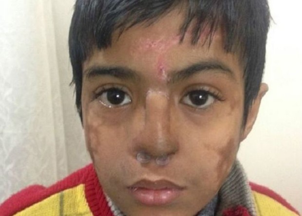 O nariz de Arun Patel ficou desfigurado após uma pneumonia (Foto: S Niazi)