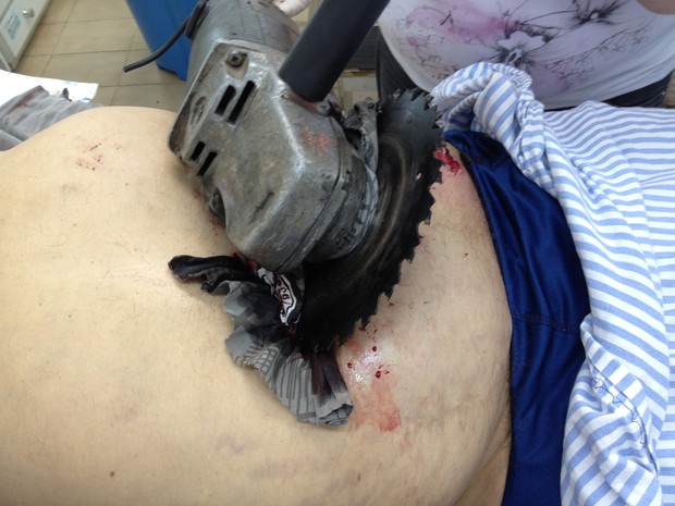 Serra elétrica cravada em abdome de agricultor no RS (Foto: Hospital Vida e Saúde/Divulgação)
