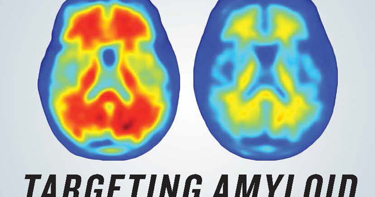 Nova terapia contra Alzheimer retarda perda de memória