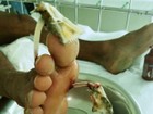 Homem passa por cirurgia após peixe ficar grudado no pé: 'Dor terrível'