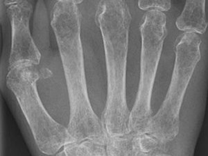 Radiografias usadas para diagnóstico precoce de osteoporose (Foto: Nevit Dilmen/via BBC)