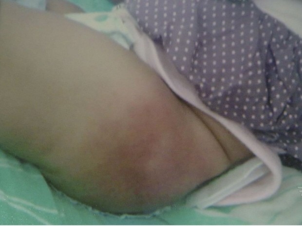 Vacina causou vergão na perna do bebê de quatro meses (Foto: Reprodução/TV Tribuna)