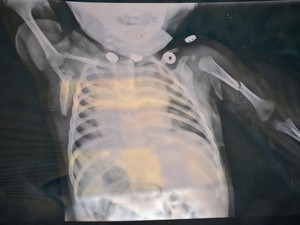 G1 - Bebê de quatro meses é agredido e tem braço quebrado no Acre