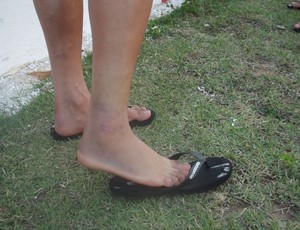 Norberto, lateral-direito do América-RN, mostra tornozelo inchado (Foto: Jocaff Souza/Globoesporte.com)