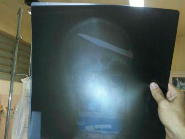 Radiografia mostra faca alojada no crânio (Foto: Polícia Militar/Divulgação)